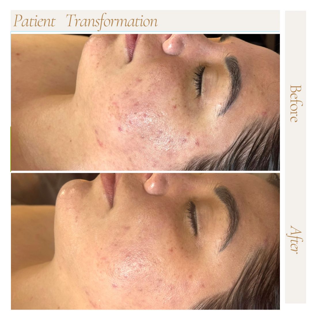 Before and after facial treatment