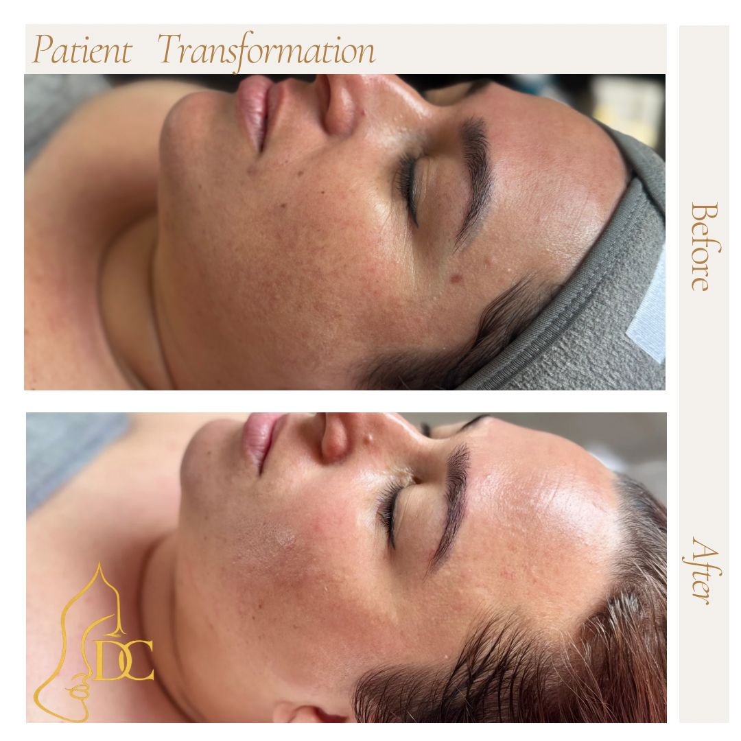 Before and after facial treatment